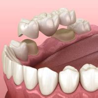 Dental Bridges In Arvada .